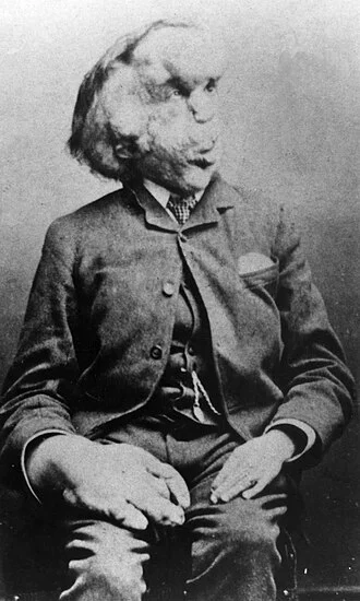 Joseph Merrick height profile photo